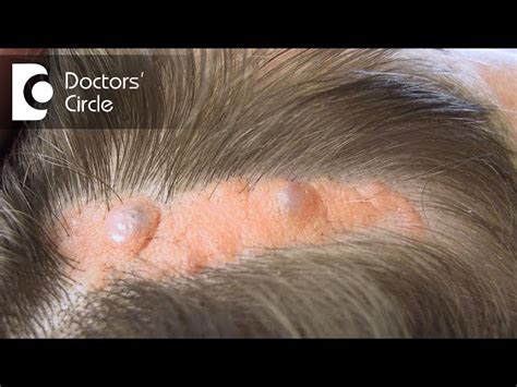 Sebaceous Cyst Scalp