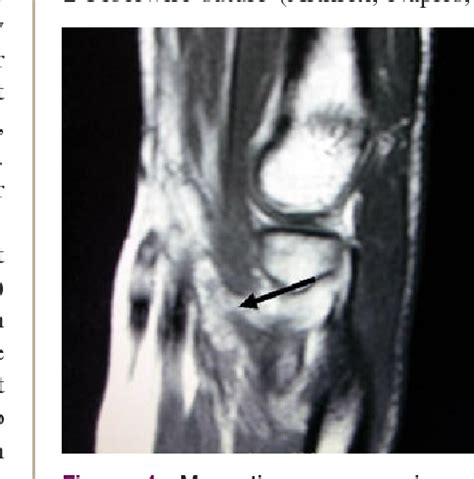 Figure From Endobutton Assisted Repair Of Complete Distal Biceps