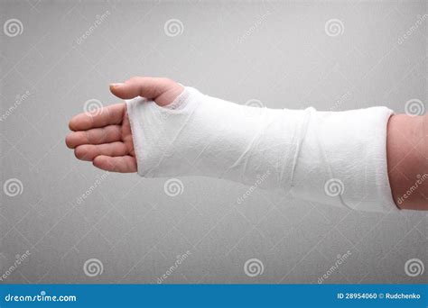 Broken arm bone in cast stock photo. Image of plaster - 28954060