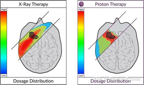 科普解读：放疗引起的放射性脑损伤 知乎