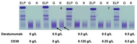 Immunofixation Shows Igg Monoclonal Protein With Kappa Light Chain