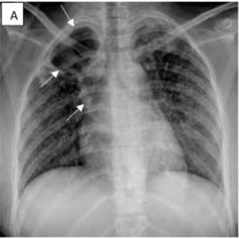 PA chest radiograph shows a right cavitary lesion (white arrows ...