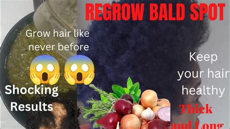 How I Use This Treatments To Grow Back Alopecia Baldness Shedding