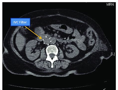 Inferior Vena Cava IVC Filter