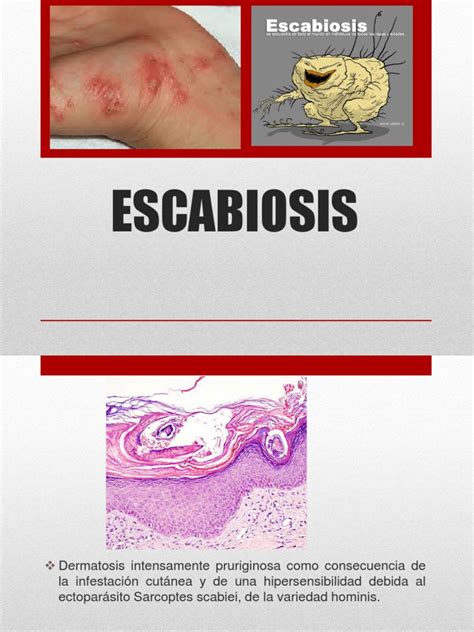 Escabiosis Sarcopte Scabiei Especialidades Medicas Medicina