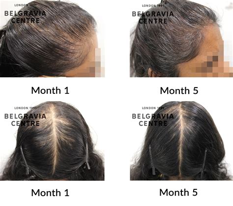 Hair Loss Success Story This Has Help Improve My Confidence As I