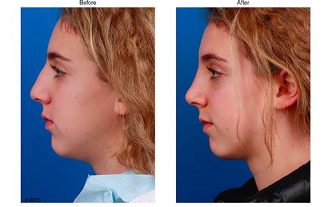 Rhinoplasty Results By Dr Miller Facial Plastic Nose Job Rhinoplasty