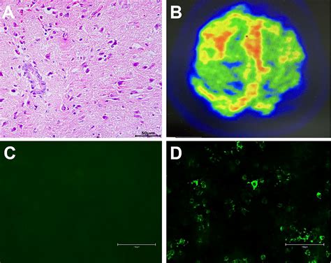 Immunoglobulin Meningitis Treatment – IDSQ