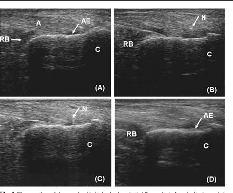 Figure 4 from Efficacy and safety of ultrasound-guided local injections of etanercept into ...