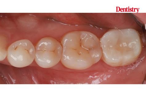 Prosthodontips Restoration Of A Lower Second Molar Dentistry