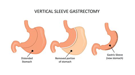 Sleeve Gastrectomy Procedure And All About It Healing Clinic Turkey