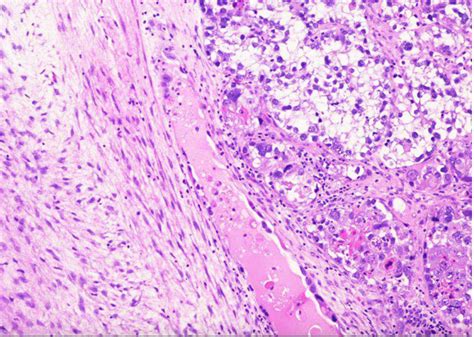 Histology slide 10×. Clear cell carcinoma has solid, diffuse pattern ...