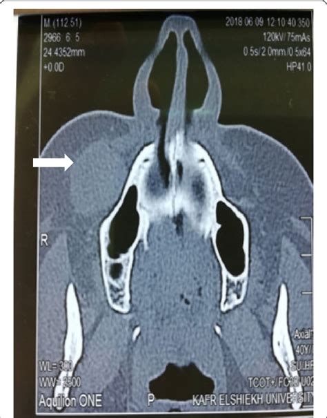 CT scan nose and PNS axial section: showing well-defined lesion in the ...