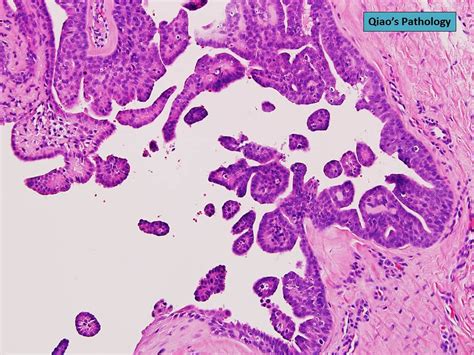 Qiao S Pathology Digital Papillary Carcinoma A Photo On Flickriver