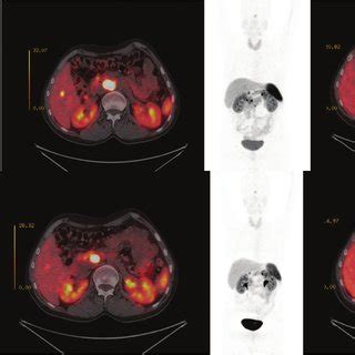 Ga-68-DOTATATE scan images | Download Scientific Diagram