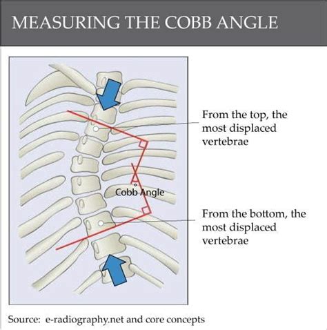 Measuring the Cobb Angle