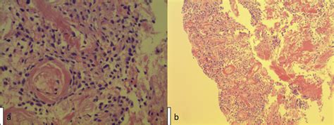 A High Power View Of The Tumor B Low Power View Showing Low Grade