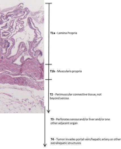 Pathology Outlines Staging Gallbladder And Cystic Duct Carcinoma