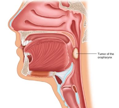 Oropharynx Cancer Treatment in Bangalore | Oropharyngeal Cancer Treatment