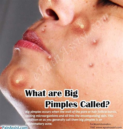 What are Big Pimples Called? #bigpimples | Big pimple, Redness pimple ...