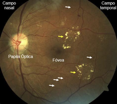 Retinografia como forma de rastreio de retinopatia diabética em