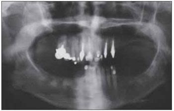 Non Syndromic Keratocystic Odontogenic Tumor Involving The Maxillary