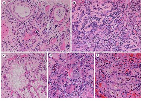 High Power Histologic Views Of The Pulse Granuloma Lesions A B