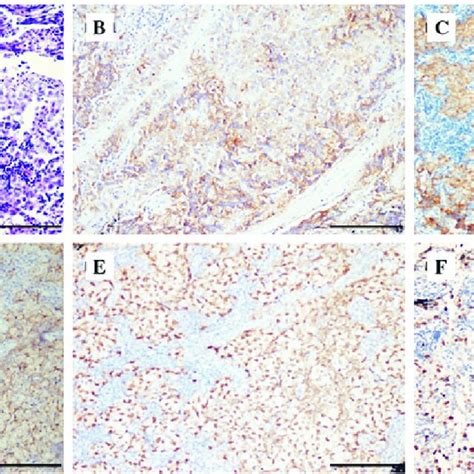 Histology and immunohistochemistry of the cervical node. (A) Tumor ...