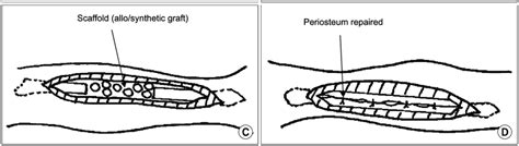 A A Longitudinal Incision Was Made On The Fibular And Its Periosteum