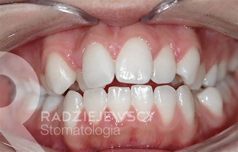 Metamorfozy Stomatologia Radziejewscy Ortodoncja I Nak Adki Invisalign