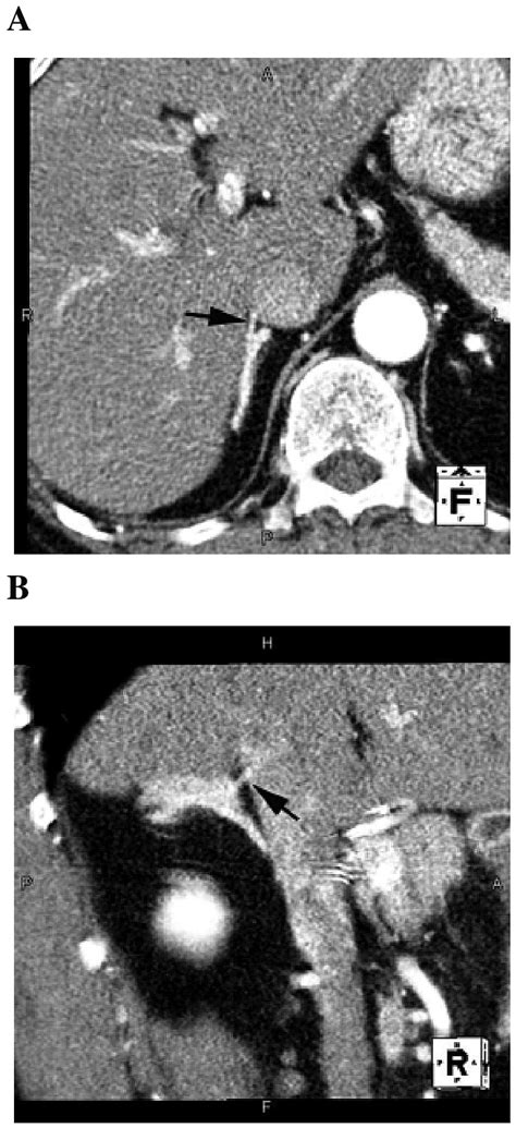 A Right Adrenal Vein Imaged By Multi Detector Row CT MDCT Anatomical