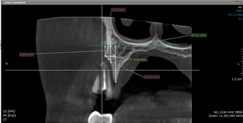 Radiographic Measurement Of Bone Width And Height Before Surgery A