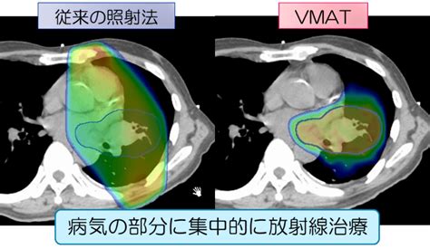 肺がん｜広島大学大学院医系学研究科 放射線腫瘍学 広島大学病院 放射線治療科