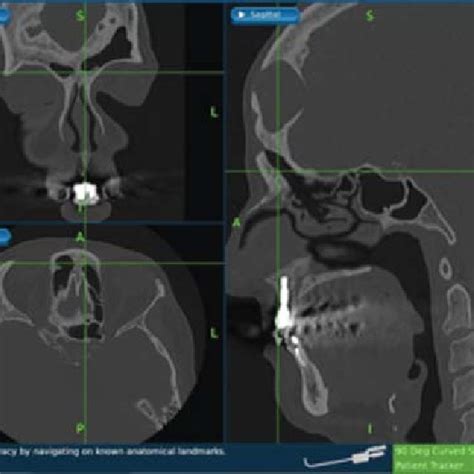 Endoscopic Anatomy Of The Left Anterior Ethmoid Artery And Its