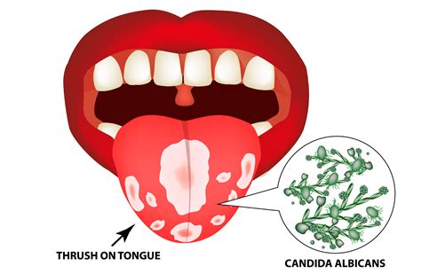 Candida Albicans Lips