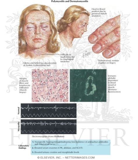 Dermatomyositis and Polymyositis