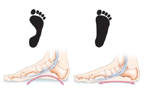 Flat Foot Treatment - Dr Gholam Sarwar