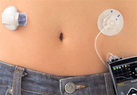 Medtronic Continuous Glucose Monitoring Ipag Scotland