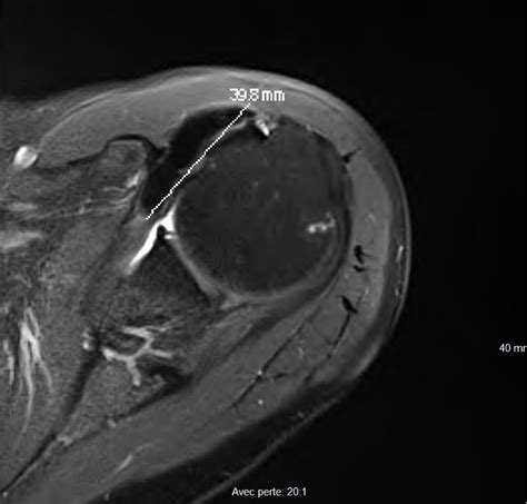 Module La Tendinopathie Calcifiante De L Paule Diagnostic Bilan