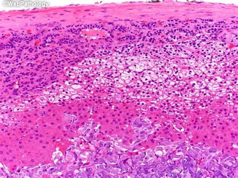 Pheochromocytoma