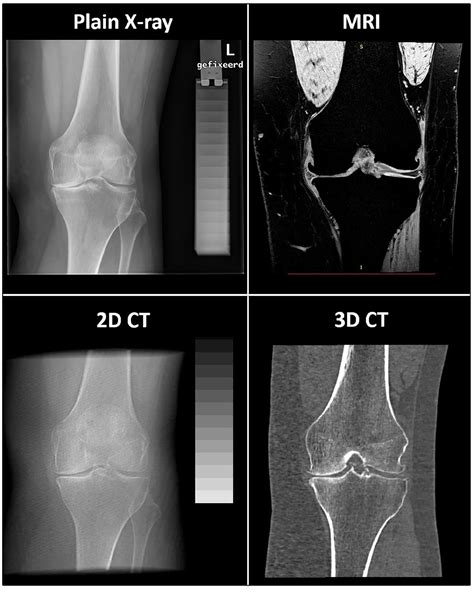 Comparison Between 2d Radiographic Weight Bearing Joint Space Width And