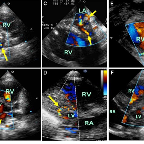 Two Dimensional Echocardiograms From Four Patients A Parasternal