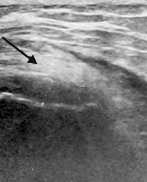 Gluteus Medius Ultrasound