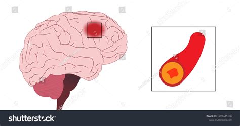 Brain Stroke Illustration Stroke Frontal Lobe Stock Illustration ...