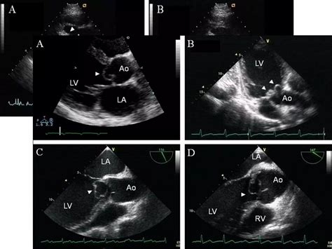 Echocardiographic Evaluation Of Aortic Regurgitation Ppt