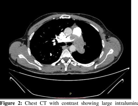 Figure 1 From Pulmonary Artery Sarcoma Diagnosed By Transbronchial