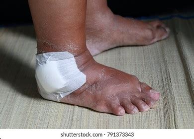 150 Lateral Malleolus Images, Stock Photos, and Vectors | Shutterstock