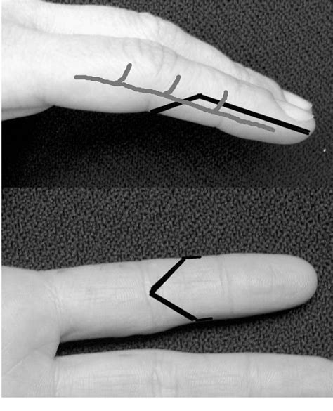 Figure 1 From Reconstruction Of Fingertip Defects With The Neurovascular Tranquilli Leali Flap