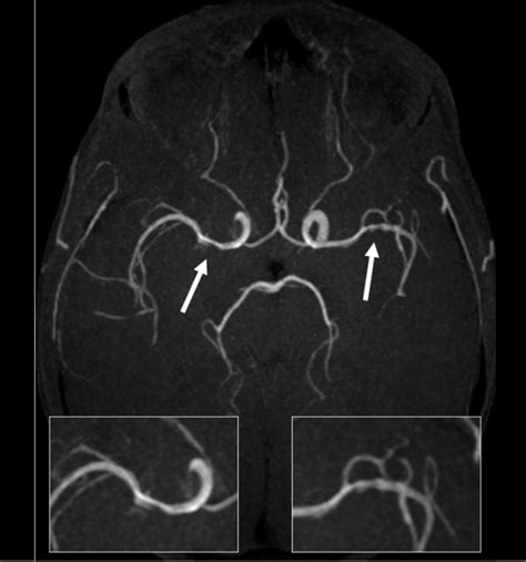 Scielo Brasil Detection Of Meningovascular Neurotuberculosis