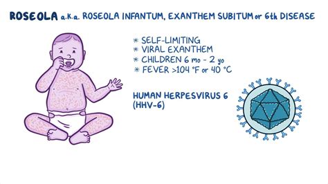 video roseola exanthem subitum nursing osmosis